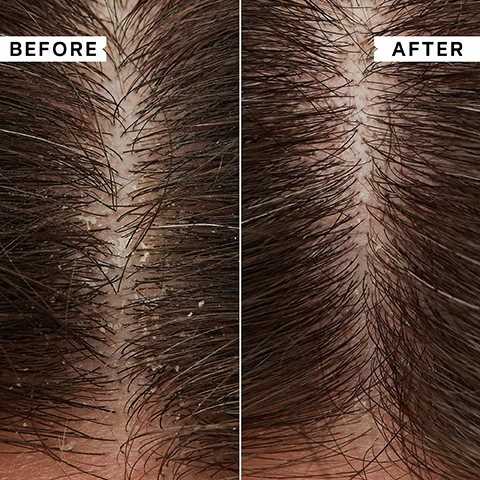 Image 1 - A split image shows a before and after comparison of a scalp: the left side has dark hair with a visible accumulation of white dandruff flakes along the part, while the right side shows the same dark hair with a clean, flake-free scalp, BEFORE, AFTER. Image 2 - A hand holds a white Philip Kingsley Flaky / Itchy Scalp Anti-Dandruff Shampoo bottle, 250 ml e 8.45 fl oz, which describes its function as Refreshes, calms and comforts the scalp Rafraîchit, apaise et soulage le cuir chevelu, and is accompanied by a list of Key Benefits: Provides instant relief for itchy, irritated scalps, Clears flaking and oil build-up, and Safe for colour-treated hair and gentle enough for daily use. Image 3 - A white Philip Kingsley shampoo bottle with a green cap and a vertical Philip Kingsley logo, dispensing clear gel, is shown alongside text that reads 100% reported it SOOTHED their scalp* and 99% reported it CLEARED their flaky scalp*, with the bottle label additionally stating FLAKY / ITCHY SCALP Refreshes, calms and comforts the scalp. Rafraichit, apaise et soulage le cuir chevelu. ANTI-DANDRUFF SHAMPOO SHAMPOOING ANTI-PELLICULAIRE 250 ml e 8.45 fl.oz, and small print below details *95-PERSON INDEPENDENT CONSUMER PERCEPTION TRIAL ALL PARTICIPANTS SUFFERED WITH DANDRUFF/FLAKY/ITCHY SCALP. Image 4 - A white Philip Kingsley shampoo bottle with green accents and clear gel at its base, labeled Philip Kingsley Flaky / Itchy Scalp Anti-Dandruff Shampoo, is displayed beside text that reads Key Ingredients Lauryl Betaine Cleanses without redness or irritation and Piroctone Olamine Antimicrobial to relieve flaking and itching. Image 5 - A hand dispenses golden shampoo from a white Philip Kingsley Flaky/Itchy Scalp bottle into another open hand, beside a customer review that reads: This shampoo is excellent for my itchy scalp, and it leaves my hair FEELING SOFT with a good shine. CUSTOMER REVIEW. Image 6 - A blonde woman is shown in a before and after comparison; on the left, labeled BEFORE, she has a neutral expression with one hand to her head, and on the right, labeled AFTER, she is smiling broadly. Image 7 - Five white and green Philip Kingsley hair care products are arranged on a light gray background to illustrate a multi-step routine, with the visible text FLAKY/ITCHY SCALP: TO SOOTHE AND CLEAR FLAKES & BUILD-UP, followed by product labels for Step 1 Mask: Philip Kingsley Flaky/Itchy Scalp Anti-Dandruff Mask; Step 2 Cleanse (FOR FINE/MEDIUM HAIR): Philip Kingsley Flaky/Itchy Scalp Anti-Dandruff Shampoo; Step 2 Cleanse (FOR CURLS): Philip Kingsley Flaky/Itchy Scalp Anti-Dandruff Shampoo for Curls; Step 3 Condition: Philip Kingsley Flaky/Itchy Scalp Conditioner; and Step 4 Toner: Philip Kingsley Flaky/Itchy Scalp Anti-Dandruff Scalp Toner.