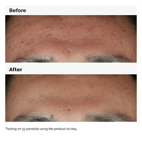 Image 1 - Image showing a close-up of a forehead divided into two sections labeled Before and After, with the Before section showing acne and uneven skin texture and the After section displaying smoother skin; testing on 33 panelists using the product 2x/day.
Image 2 - A close-up of a persons face with a neutral expression, lightly touching their cheek, accompanied by text that reads, Boosts skin brightness and improves skin smoothness. 10% Niacinamide 1% Zinc PCA.
Image 3 - A top-down view of a clear glass dish containing two droplets of a lightweight, water-based serum with bubbles, accompanied by text that reads Niacinamide 10% + Zinc 1% Lightweight water-based serum texture.
Image 4 - Image shows a visual guide for skincare products divided into three sections labeled PREP for cleansers and toners, TREAT for water-based serums, eye serums, anhydrous solutions, and oils, and SEAL for suspensions, moisturizers, and SPF.