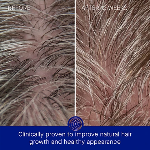 Image 3 - Image shows a comparison of hair growth on a scalp, with the left side labeled Before showing sparse hair and the right side labeled After 12 Weeks showing fuller hair, with visible text below stating Clinically proven to improve natural hair growth and healthy appearance.
Image 4 - Image shows a comparison of hair before and after 12 weeks of treatment, with the left featuring frizzy, dull hair and the right displaying smoother, shinier hair; visible text includes BEFORE, AFTER 12 WEEKS, and Clinically proven to enhance hair shine and strength.
Image 5 - A blue tube of Augustinus Bader conditioner is displayed on a light background with visible text stating Clinically Proven Results, followed by claims that hair strength is increased by 2.1x, hydration by 97%, and appears healthier by 2.3x, along with a note about a clinical trial.
Image 6 - Image shows a blue tube of conditioner held in a hand against a light green textured background, with visible text stating User Proven Results, 97% agree The Conditioner visibly improves natural hair growth, 100% agree hair breakage is visibly decreased, 100% agree hair felt more hydrated, and *In a 12-week Consumer Perception Study of 105 m/f with all hair types.
Image 7 - A blue tube of Augustinus Bader conditioner is centered against a gradient background, with text highlighting key ingredients and benefits: TFC8® - A proprietary technology that creates the optimal environment for skin cellular renewal, Castor Seed Oil - Reduces breakage and improves elasticity, Oat Kernel Oil - Supports elasticity, nourishes, and hydrates hair, and Pomegranate Extract - Protects against visible signs of damage.
Image 8 - Image shows two product tubes side by side: on the left, The Conditioner, described as a lightweight cream conditioner with text indicating key benefits, concerns, and ideal hair types; on the right, The Rich Conditioner, described as a rich silky conditioner with similar informational text, all set against a contrasting background.
Image 9 - Image shows a product application guide with three steps: Step 1: Apply to clean, damp hair; Step 2: Work through the length of the hair using The Neem Comb or your fingers, starting from the midshaft of the scalp (as needed); Step 3: Rinse thoroughly after 1-2 minutes. The background features a decorative design.