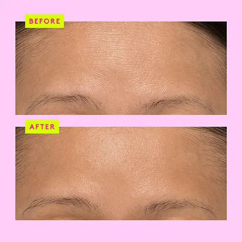 Image 1, BEFORE AFTER Image 2, T.L.C. FramboosTM AHA blend Resurfaces and exfoliates skin for a smoother, more even-looking complexion. Salicylic acid (BHA) Loosens sebum to unclog pores while soothing skin. TLC. Framboos" Gyvele Night Serum Sérum de mult Bolique Raspberry fruit extract Rehydrates and soothes skin; fights free radicals with antioxidants. xx AAA Extr xx Image 3, face off serum edition T L C glycolic serum key ingredients 10% AHA and 1% BHA perfect for anyone looking for a powerful nightly exfoliant to resurface and improve the look of skins tone and texture fine lines and pores c firma fresh day serum key ingredients 15% l ascorbic acid and ferulic acid perfect for anyone looking to brighten uneven tone and firm skin and wants the freshest vitamin C around protini powerpeptide resurf serum key ingredients 10%b lactic acid and 11 signal peptides perfect for anyone looking for gentle AHA exfoliant with a shot of peptides to achieve plump smooth and radiant skin Image 4, T.L.C. ❤s F-Balm Use T.L.C. Framboos for a gentle chemical exfoliation that clears the way for maximum absorption of F-Balm. Step 1 Apply 1 pump T.L.C. Framboos for gentle chemical exfoliation or your favorite p.m. skincare smoothie. Step 2 Top it off with 4-5 pumps of F-Balm to plump and restore. Step 3 Lights out. TLC X + Top it off! F-Balm" Electrolyte Waterfacial Masque hydratant