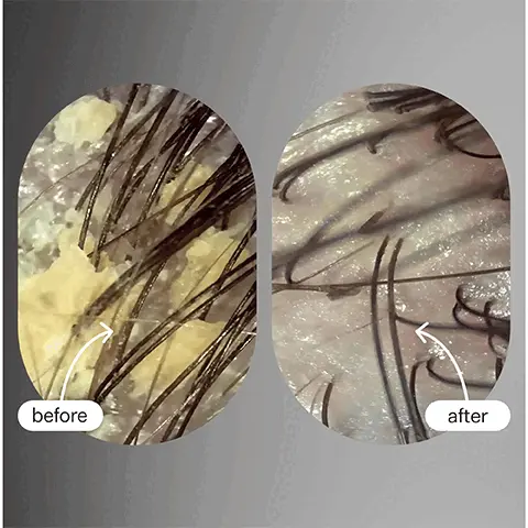 Image 1, Real Results before and after one use, image shows dandruff before and clear glossy hair after. Image 2, Real Results, before and after one use, image shows a flaky scalp before and a clear scalp after. Image 3,Proven results: 95% agreed build up was reduced, 89% agreed scalp felt soothed and 87% agreed irritation was soothed. These results are from a consumer perception study with all hair and scalp types. Image 4, Breakdown chart of all ingredients: Basil Leaf (1.37%) Clinically proven to stimulate hair follicles for hair retention Baobab Oil (1.28%) Cleansing properties help breakdown dirt, sweat + product build up while nourishing scalp microbiome. Moringa Oil (1.28%) Anti-fungal + antimicrobial properties help rebalance the scalp + supports a moisturized scalp for healthy-looking hair Production Ethical Labor: 100% Manufacturing Method: Cold Processed Packaging: Bottle PET Plastic, Nozzle PET Plastic, Recyclability 85%, Box Material Certified Post Recycled Image 8, loved by goop, Forbes, Coveteur, Elite Daily, Byrdie. Image 5,What to expect: 1-2 uses removes itch causing buildup, 3-4 uses protects scalp moisture barrier and 5-6 uses scalp feels hydrated moisturised and balanced. Image 6, 5 stars, made my scalp feel amazing, 500k 5 star reviews. Image 7, Loved By: vogue, coveteur, allure, forbes and elite daily