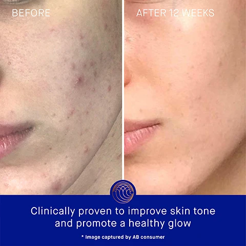 Image 3 - Side-by-side comparison of a persons face showing skin with acne before treatment on the left and improved, clearer skin 12 weeks after treatment on the right, with visible text stating BEFORE and AFTER 12 WEEKS and a caption at the bottom reading Clinically proven to improve skin tone and promote a healthy glow.
Image 4 - A blue and gold skincare bottle labeled Augustinus Bader is shown against a gradient background, with text stating Clinically Proven Results, Skin looks 52% younger, Skin hydration is improved by 3.3x after 1 hour, The appearance of fine lines and wrinkles are reduced by 32%, and additional notes about clinical trials.
Image 5 - A skincare product with a blue bottle displays user proven results, stating 83% agree skin feels instantly and deeply hydrated, 92% agree dull skin appears more luminous, and 79% agree skin discoloration is diminished and skin looks more even, with a note about a 4-week consumer perception study of 52 participants at the bottom.
Image 6 - A skincare product bottle with a blue and copper design labeled Augustinus Bader is shown on a white cream background, with text highlighting benefits of TFC8®, Vitamin A, Vitamin B5, and Vitamin C, stating their effects on skin renewal, reducing fine lines, moisture retention, and brightening complexion.
Image 7 - Two skincare products are displayed side by side: The Cream, a lightweight daily moisturizer in a blue and gold bottle, and The Rich Cream, a luxuriously rich daily moisturizer in a similar blue and gold bottle; text includes descriptions for each products texture, key benefits, key concerns, and ideal skin types.
Image 8 - A skincare routine guide displaying four steps: 1. Cleanse with the cream cleansing gel, 2. Correct & Hydrate with the serum, 3. Nourish & Renew with the cream, the rich cream, or the ultimate soothing cream, and 4. Perfect & Revitalize with the eye cream.
Image 9 - Four skincare products in blue bottles with metallic gold caps are displayed on a white background, showing sizes of 15 ml, 30 ml, 50 ml, and 100 ml, with visible text reading THE CREAM WITH TFC8 and Augustinus Bader.