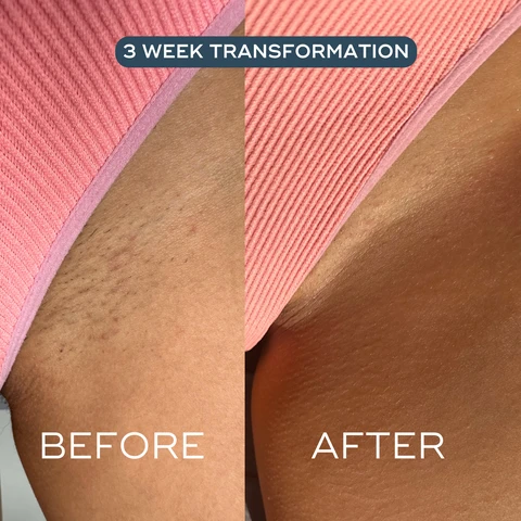 Image 1, 3 week transformation before and after. image 2, multi-tasking oil for ingrown hairs, razor rash, redness, bumps and more. for all skin even intimate. image 3, after 2 weeks 92% dry skin visibly improved. 85% reduced irritation caused by hair removal, 83% reduced redness, 81% reduced appearance of bumps. clinical user trial, 102 women of all ages, stages and skin types. image 4, customer review - one oil to rule them all. this is incredible, been using on my pubic skin and underarms as i always get ingrowns and red bumps after shaving. after literally a few uses (and the tiniest amount needed as a little goes a long way) i have no redness and two ingrowns in my groin have disappeared don't hesitate. image 5, travel size on the go. small but mighty, 1 month supply. image 6, how to recycle - separate cap from pipette, rinse bottle, recycle cap, bottle and tube.