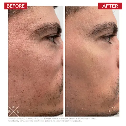 Image 1, BEFORE AFTER dr P Clinical case study. 4 weeks. Products: 3Deep Cleanser + Booster Serum + R' Cell Matrix Mask Results may vary according to different patients. Scientific Cosmeceuticals SA, dr Image 2, Dr. LEVY SWITZERLAND INTENSE STEM CELL Booster Serum Serum Activateur Face Visage 审审审审车里 This is how much revitalisation you can get! Image 3, BEFORE P dr Dr. AFTER Clinical case study. 6 weeks. Product: Booster Serum Results may vary according to different patients. Scientific Cosmeceuticals SA.