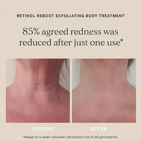 Retinol reboot exfoliating body treatment, 85% agreed redness was reduced after just one use, before, after, based on a 4-week consumer perception trial of 20 participants. Retinol reboot exfoliating body treatment, 85% agreed skin was firmer after just 2 weeks, before, after, based on 4-week consumer perception trial of 20 participants.