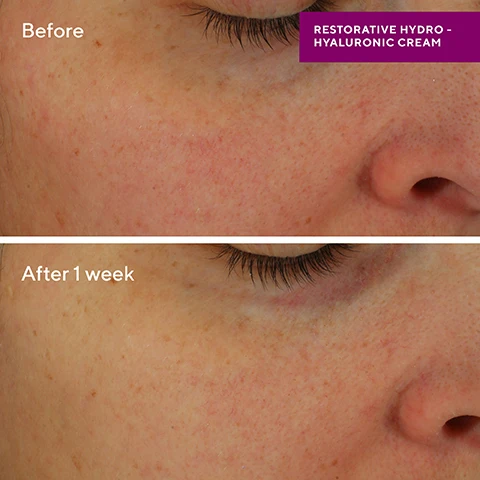 image 1, before and after 1 week. image 2, ultimate routine for smooth and plump skin. 1 = cleanse with AHA/BHA exfoliating and pat dry. 2 = apply revitalixir recovery serum over face, neck and chest. gently pat around the eye area. 3 = apply restorative hydro hyaluronic cream over face, neck and chest. image 3, find your ultimate moisturiser. nutrient charged water gel - combination to oily skin type, silky gel. restorative hydro hyaluronic cream - dry to extremely dry skin types, ultra rich yet fast absorbing cream. intense recovery cream - dry to combination skin types, lightweight cream. image 4, advanced hyaluronic acid technology - penetrates deep into skin for instant and lasting hydration. coconut extract - prevents water loss. shea butter and sunflower oil - provides long long lasting moisture. image 5, new name, same superior moisture. we updated the name to better reflect the advanced hyaluronic acid technology, as well as the multi functional benefits of this luxurious moisturising cream. old look vs new. image 5, restorative hydro hyaluronic crea, - immediately smooths and plumps skin. provides 24 hours of intense hydration. restores the skin barrier in just 1 use. number 1 US dermatologist founded brand. image 6, founded by dr murad. number 1 US dermatologist founded brand with 30 years of unmatches clinically proven results.