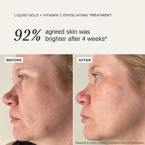 Image 1 - Side-by-side comparison of a womans face showing the effects of a Liquid Gold + Vitamin C Exfoliating Treatment, with the left side labeled Before displaying more blemishes and the right side labeled After showing clearer skin, along with the text 92% agreed skin was brighter after 4 weeks and a note about a consumer perception trial.
Image 2 - A golden bottle labeled ALPHA-H LIQUID GOLD™ VITAMIN C is featured against an orange background, with text describing the benefits of Glycolic Acid, Vitamin C, Tazman Pepper, and Silk Proteins.
Image 3 - A hand holding a bottle of Alpha-H Liquid Gold exfoliating treatment, with statistics stating 92% agreed skin was brighter after 4 weeks, 85% noticed more radiant skin overnight, and 81% saw an improvement to skin tone after 4 weeks.