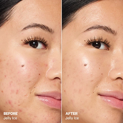 Image 1 - A split image shows a close-up of a persons face with acne before treatment on the left and a clearer complexion after treatment on the right, with visible text labeling the sides as BEFORE and AFTER Jelly Ice.
Image 2 - A blue cosmetic container labeled Milk Makeup is surrounded by water droplets and green plant elements, with text highlighting features like Calms Redness, Protects Skin, and Instantly Soothes.
Image 3 - A close-up of a womans face is shown in two panels labeled BEFORE and AFTER, highlighting the effects of a product named Jelly Ice, with visible differences in skin texture and glow.