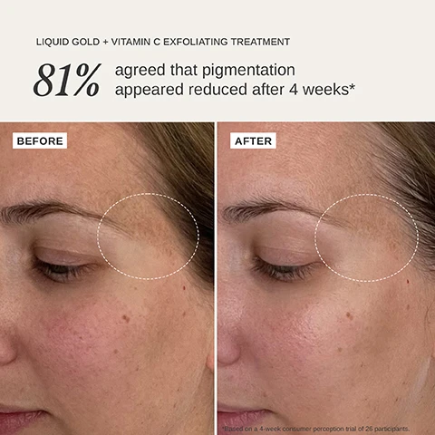 Image 1 - The image shows before and after photos of a face illustrating reduced pigmentation, with text that reads LIQUID GOLD + VITAMIN C EXFOLIATING TREATMENT 81% agreed that pigmentation appeared reduced after 4 weeks* Based on a 4-week consumer perception trial of 26 participants. Image 2 - A hand holds a white bottle next to text that reads 92% AGREED SKIN WAS BRIGHTER AFTER 4 WEEKS 85% NOTICED MORE RADIANT SKIN OVERNIGHT 81% SAW AN IMPROVEMENT TO SKIN TONE AFTER 4 WEEKS ALPHA H LIQUID GOLD + VITAMIN C EXFOLIATING TREATMENT WITH 5% GLYCOLIC ACID 100 ml / 3.38 fl.oz *Based on a 4-week consumer perception trial of 26 participants. Image 3 - An Alpha-H Liquid Gold + Vitamin C Trial Kit box, packets, and a pad are shown with text reading One step for dullness sun damage uneven tone & texture Discover if Liquid Gold + Vitamin C is right for your skin Glycolic Acid + Vitamin C for brighter more even skin - fast! Try before you buy full size with 3 pre-soaked exfoliating pads LIQUID GOLD + VITAMIN C TRIAL KIT. Image 4 - Before and after comparison of a womans face showing skin improvement with text LIQUID GOLD + VITAMIN C EXFOLIATING TREATMENT 92% agreed skin was brighter after 4 weeks* BEFORE AFTER *Based on a 4-week consumer perception trial of 26 participants.