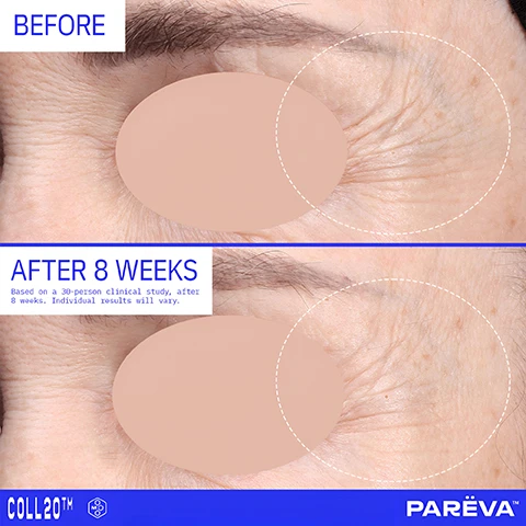 Image 2 - A before and after comparison image shows the skin around an eye, with the top panel labeled BEFORE displaying more visible wrinkles within a highlighted circular area, and the bottom panel labeled AFTER 8 WEEKS showing a reduction in these wrinkles, accompanied by the text Based on a 30-person clinical study, after 8 weeks. Individual results will vary., and the logos COLL20™ and PAREVA™. Image 3 - The image displays a before and after comparison of a persons facial skin, with the top section showing prominent wrinkles labeled BEFORE, and the bottom section showing visibly smoother skin with reduced wrinkles labeled AFTER 8 WEEKS, accompanied by the text Based on a 30-person clinical study, after 8 weeks. Individual results will vary., and logos COLL20™ and PAREVA™. Image 8 - A blue jar of Parëva Coll20 Gel Cream Moisturizer is depicted centrally on a light background, displaying its label PARËVA™ COLL20™ GEL CREAM MOISTURIZER WITH MOLECUR 3™ and listing + Vegan Collagen Modulators + Regenerating Peptides + Senolytic Longevity Boosters + Super Hydrators; surrounding text provides further details: BIOACTIVE INGREDIENTS: 20%, POLYPEPTIDE 69 VEGAN COLLAGEN Bio-identical collagen peptide; NIACINAMIDE Form of B3 that has multiple benefits Known to improve skins barrier function; WATERMELON FRUIT EXTRACT APPLE FRUIT EXTRACT LENTIL FRUIT EXTRACT Optimized delivery system to target NMF (natural moisturizing factors in the skin); MOLECUR 3™ accompanied by a stylized M logo, Longevity superstar with exosomes and NAD+; WILLOWHERB Senolytics is a groundbreaking technology that target senescent skin; and SQUALANE HYDRATING PEPTIDES SACCHARIDE ISOMERATE Hydrating and moisturizing skin while locking in moisture Improving skins barrier function and preventing waterless. Image 9 - The image shows a blue skincare jar labeled Pareva Coll20th Gel Cream Moisturizer with Molecule 3, surrounded by icons for Collagen Essence, Collagen Peptide Moisturizer, and Hydrating Serum, indicating it combines these products, with additional text stating 1 JAR. 3 PRODUCTS. 20% COLLAGEN BIOACTIVES. + Vegan Collagen Modulators + Regenerating Peptides + Senolytic Longevity Boosters + Super Hydrators. NO FUSS. JUST RESULTS.